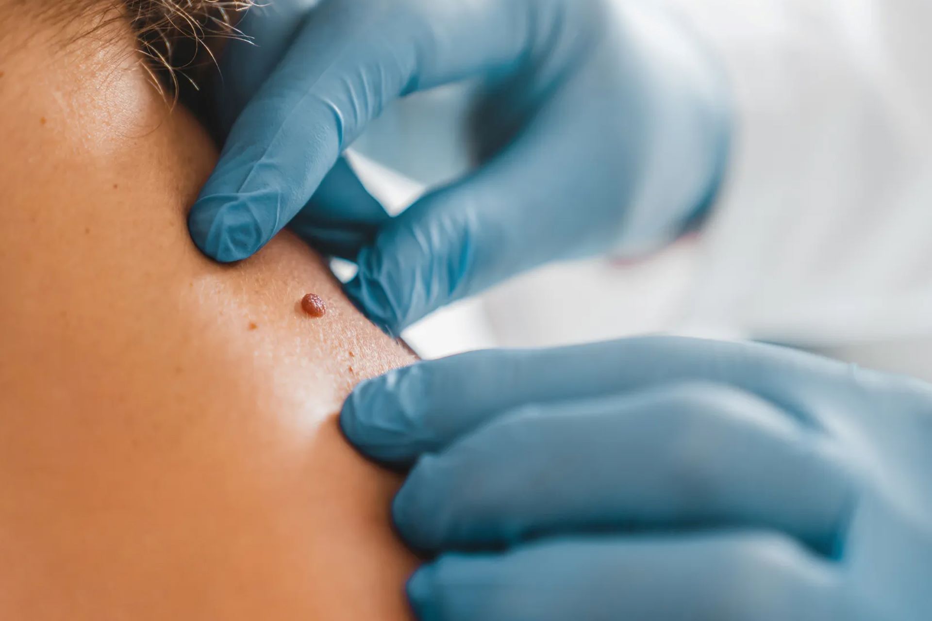 Skin Tag Removal