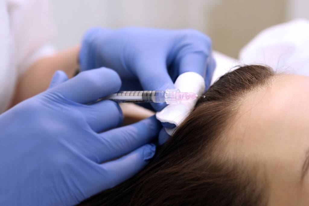 Scalp Mesotherapy