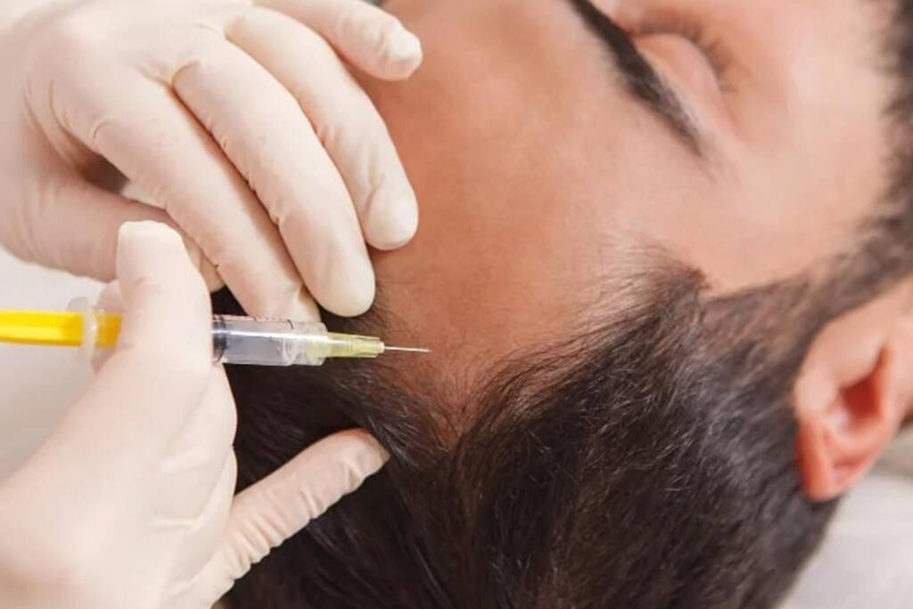 Scalp Mesotherapy