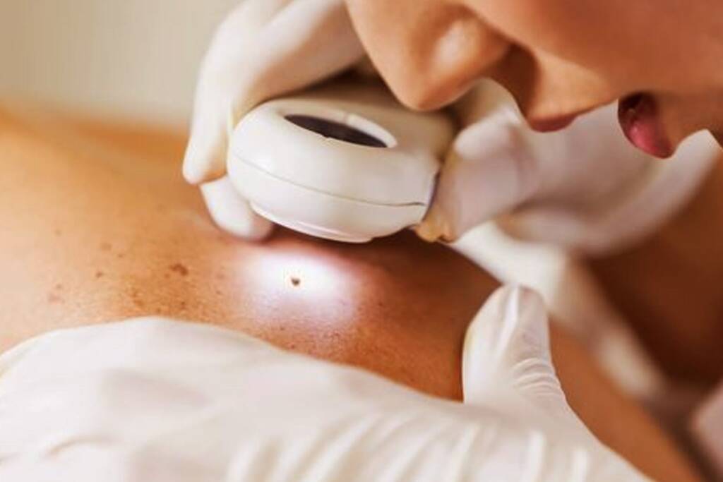 Skin Tag Removal