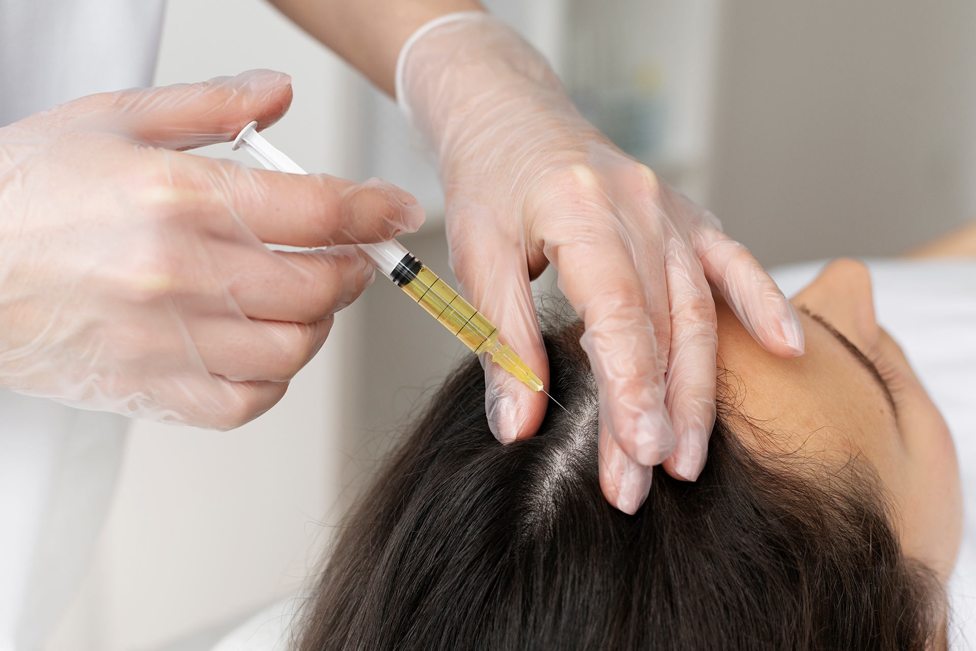 Scalp Mesotherapy