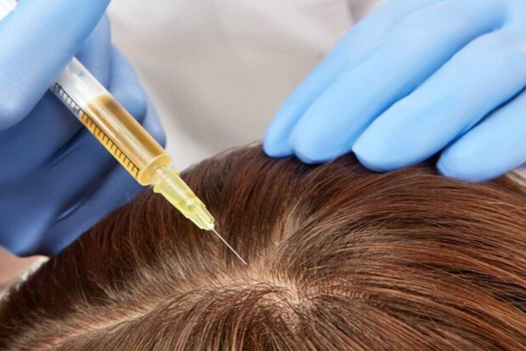 Scalp Mesotherapy